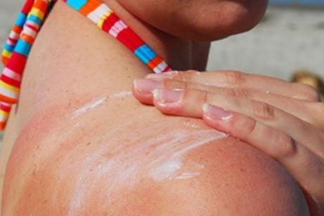 Which means for sunburn is better - the secrets of beautiful and healthy skin