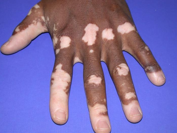 What are the symptoms and causes of vitiligo?