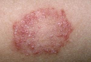 Ringworm from people. Symptoms of infection