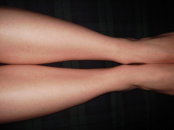 swelling of the legs after childbirth