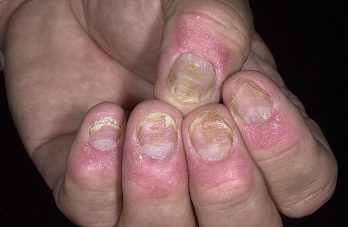 Psoriasis: what is it and how to treat it