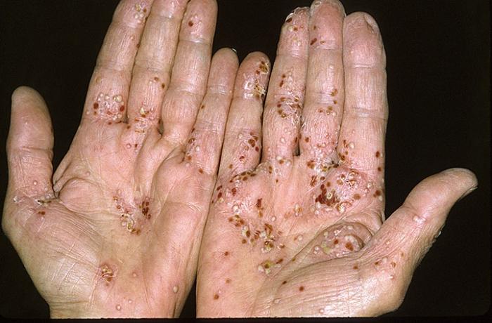 Psoriasis: a symptom that will indicate the disease