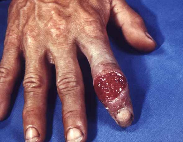 Syphilis: a symptom of the disease and treatment
