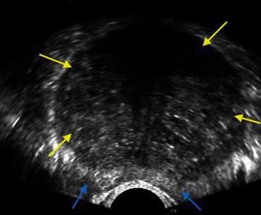 Transrectal ultrasound of the prostate: description, preparation and recommendations
